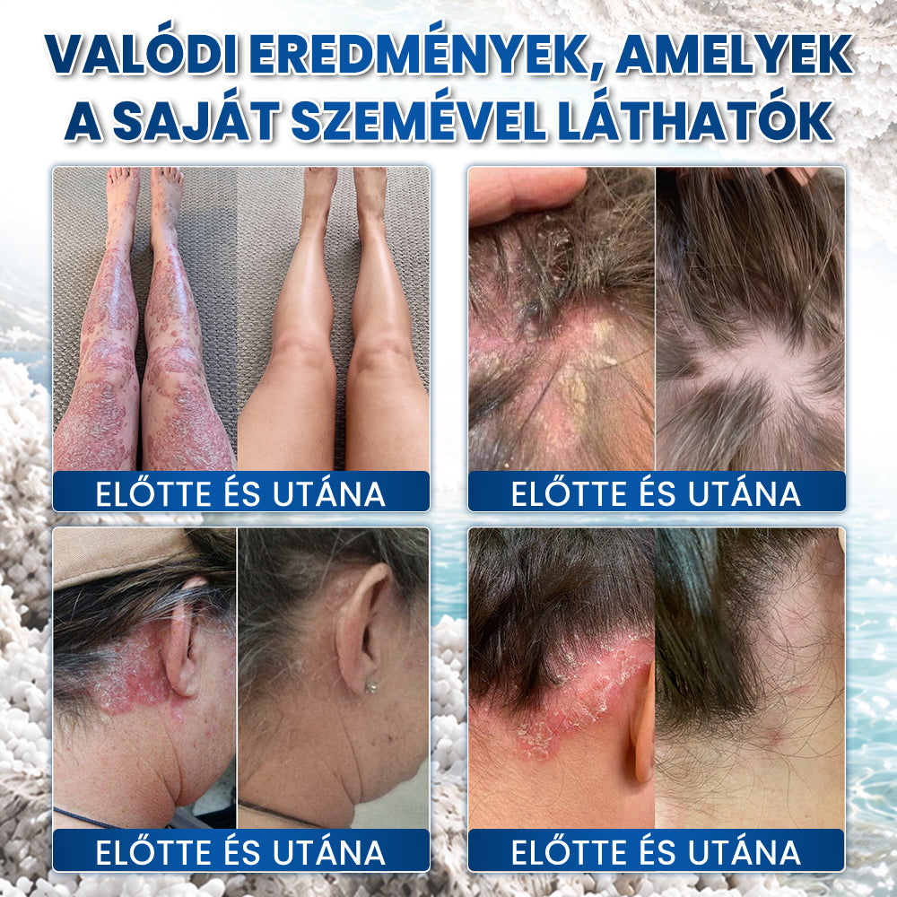 Medistart® PSZORIÁZIS SPECIÁLIS BŐRÁPOLÓ